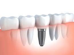 Implant dentaire turquie