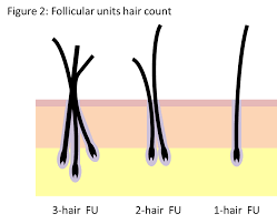 Nombre greffons par cheveux