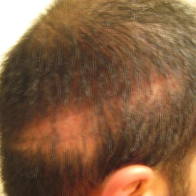 صدمة تساقط الشعر بعد زراعة الشعر